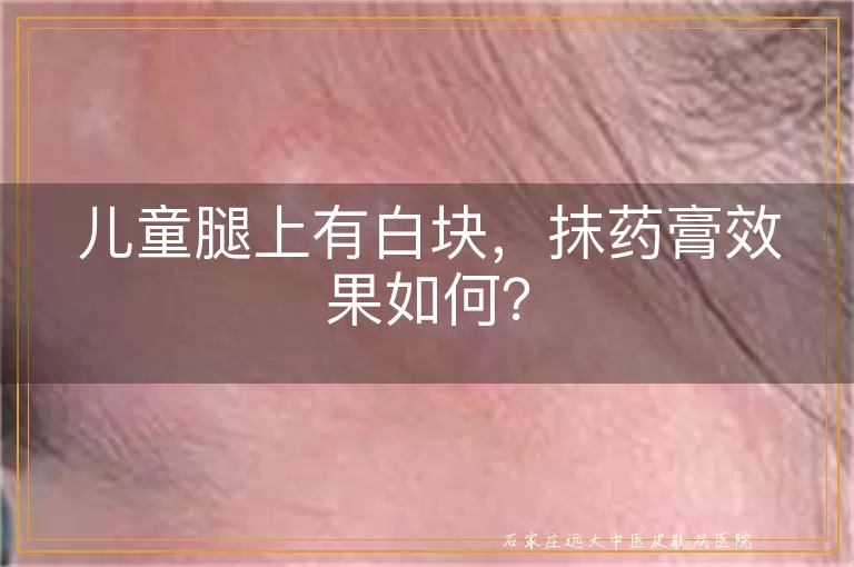 儿童腿上有白块，抹药膏效果如何？