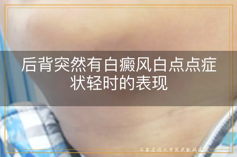 后背突然有白癜风白点点症状轻时的表现