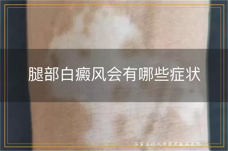 腿部白癜风会有哪些症状