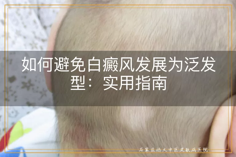 如何避免白癜风发展为泛发型：实用指南