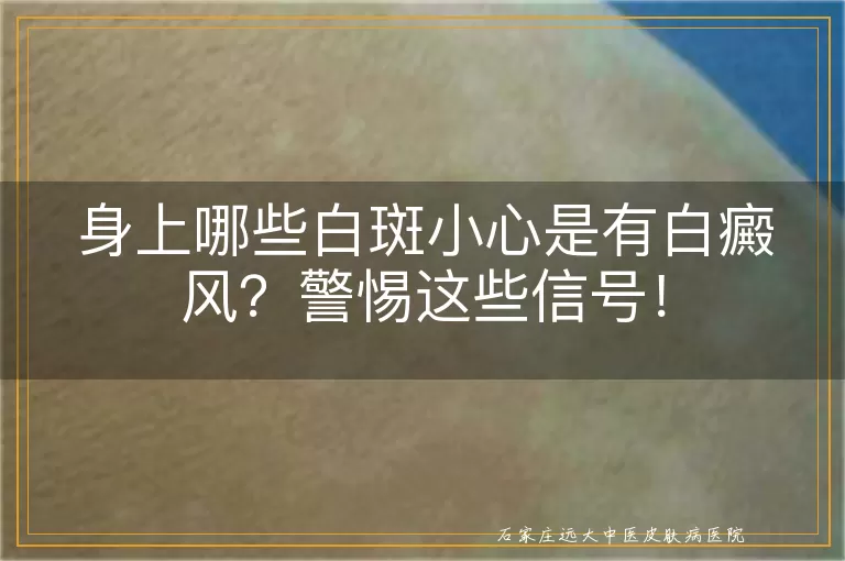 身上哪些白斑小心是有白癜风？警惕这些信号！