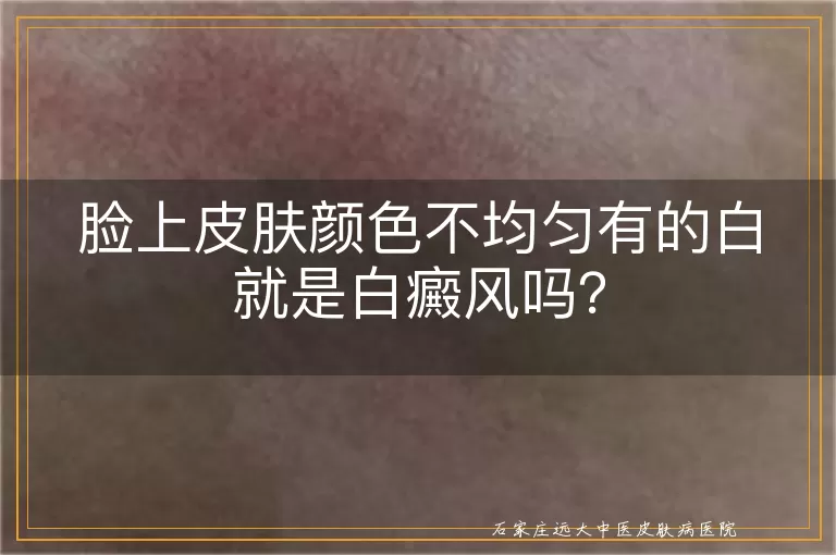 脸上皮肤颜色不均匀有的白就是白癜风吗？
