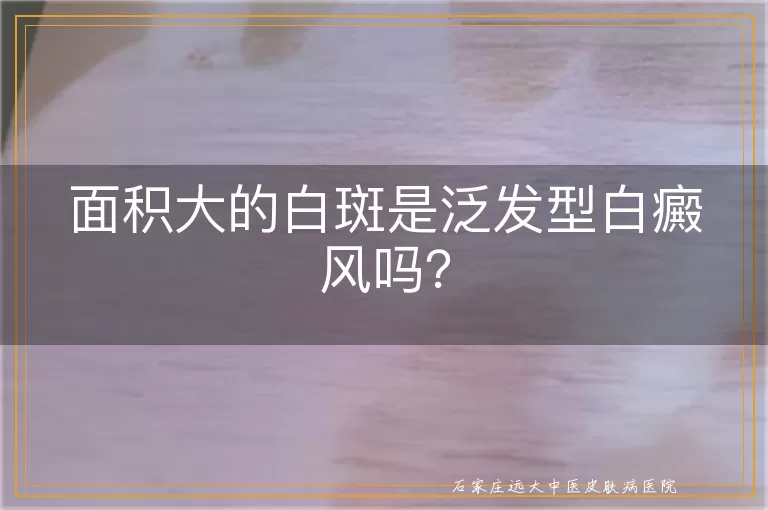 面积大的白斑是泛发型白癜风吗？