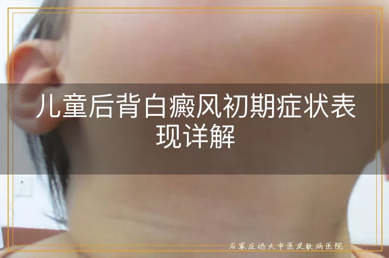 儿童后背白癜风初期症状表现详解