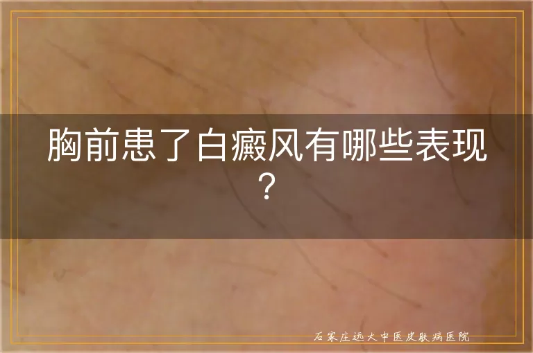 胸前患了白癜风有哪些表现？