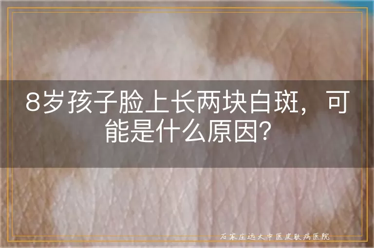 8岁孩子脸上长两块白斑，可能是什么原因？