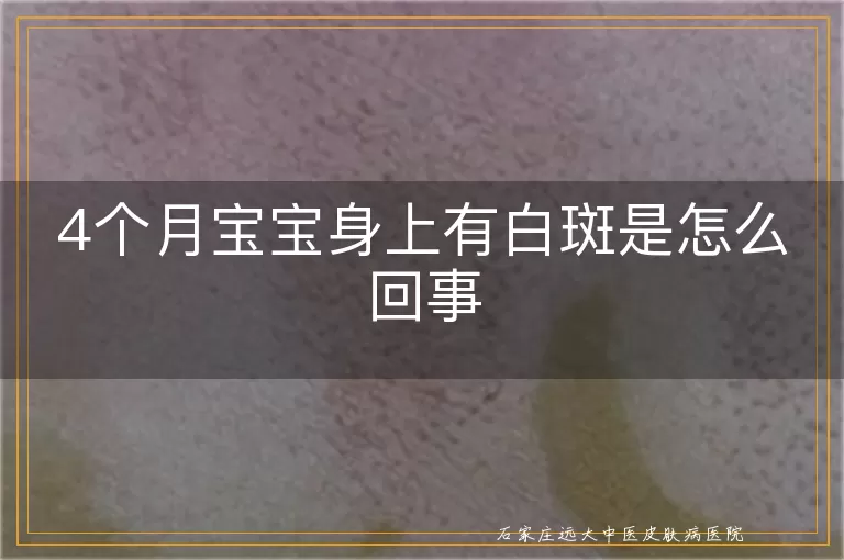 4个月宝宝身上有白斑是怎么回事
