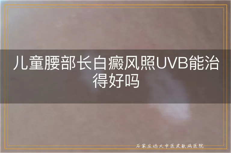 儿童腰部长白癜风照UVB能治得好吗