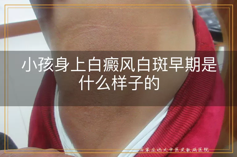 小孩身上白癜风白斑早期是什么样子的