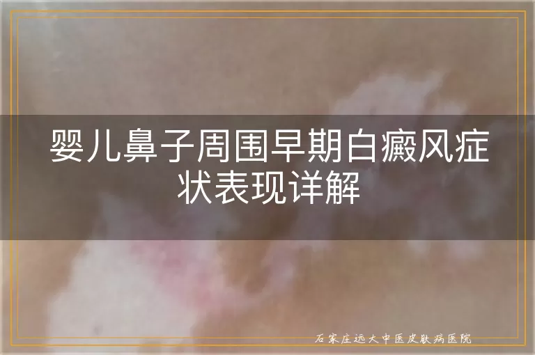 婴儿鼻子周围早期白癜风症状表现详解