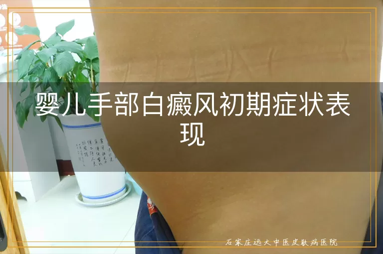 婴儿手部白癜风初期症状表现