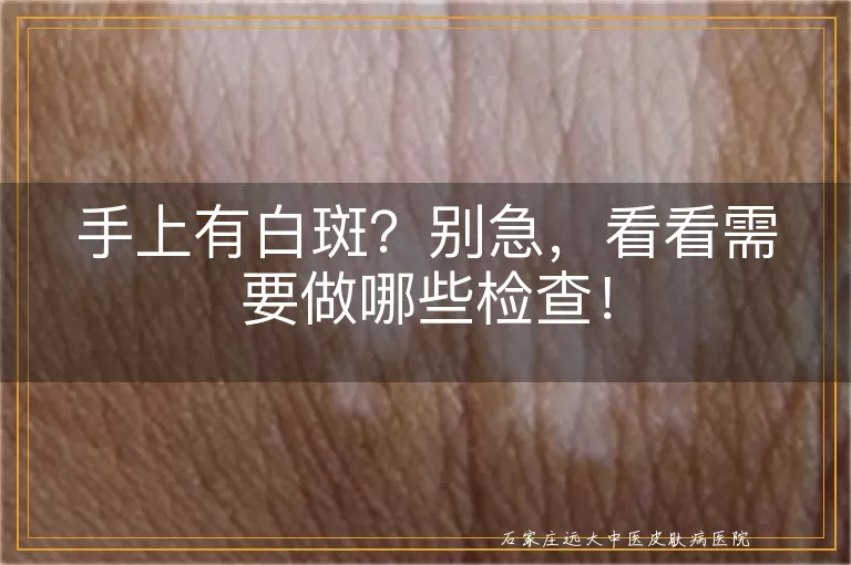手上有白斑？别急，看看需要做哪些检查！