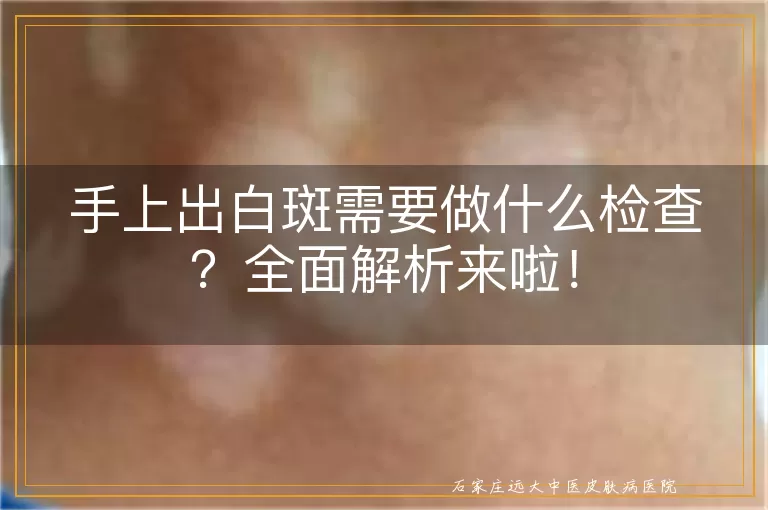 手上出白斑需要做什么检查？全面解析来啦！