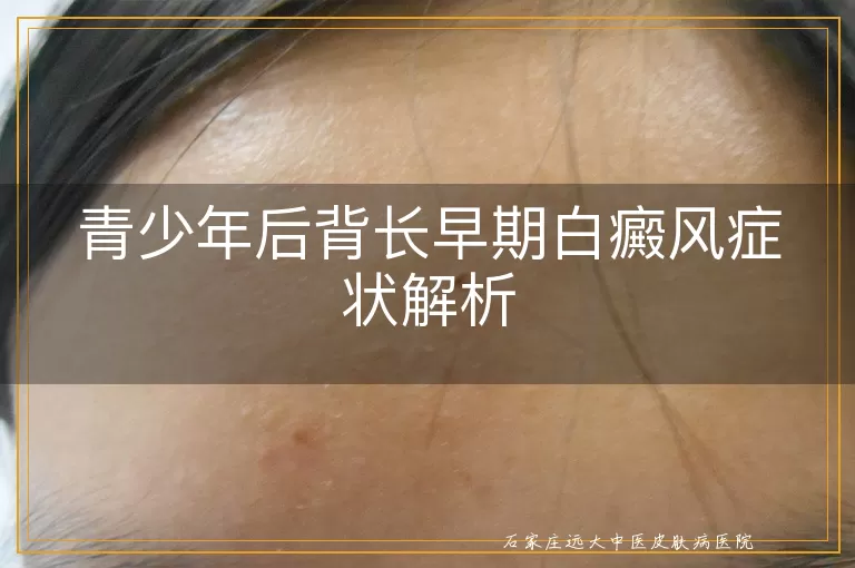 青少年后背长早期白癜风症状解析