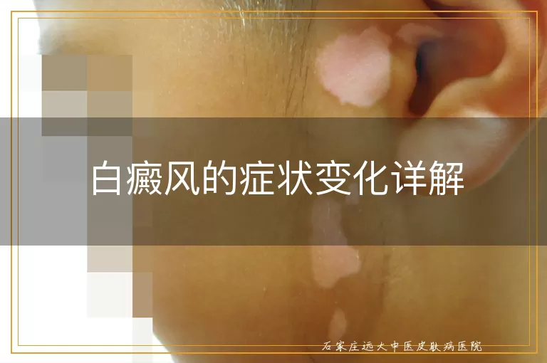 白癜风的症状变化详解