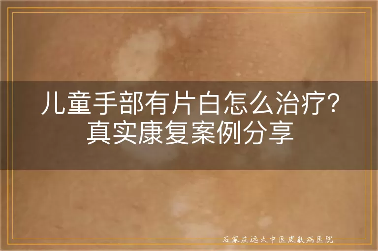 儿童手部有片白怎么治疗？真实康复案例分享