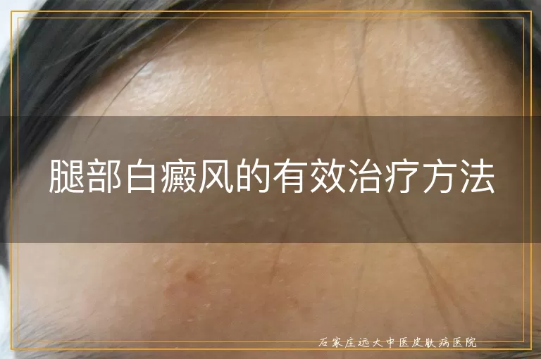 腿部白癜风的有效治疗方法