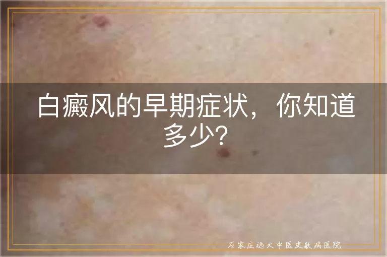 白癜风的早期症状，你知道多少？