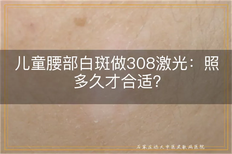儿童腰部白斑做308激光：照多久才合适？