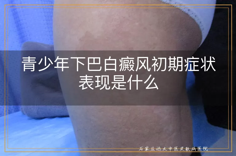 青少年下巴白癜风初期症状表现是什么