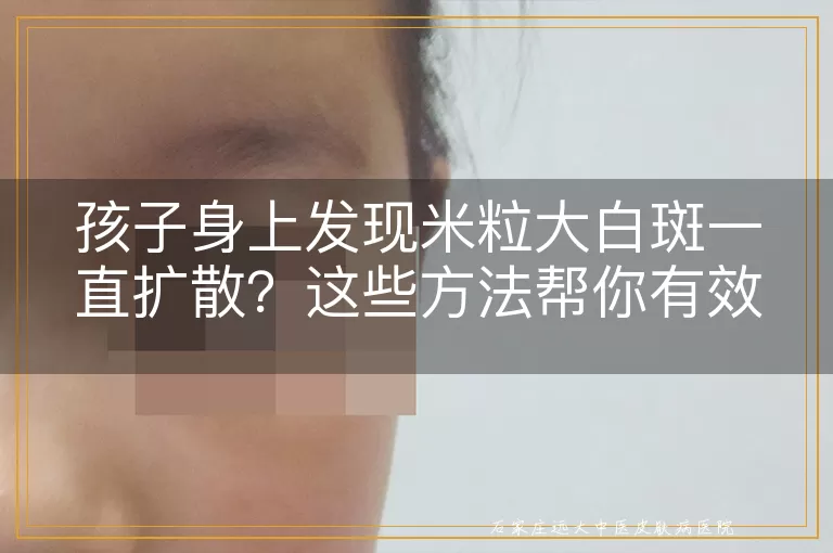 孩子身上发现米粒大白斑一直扩散？这些方法帮你有效控制！