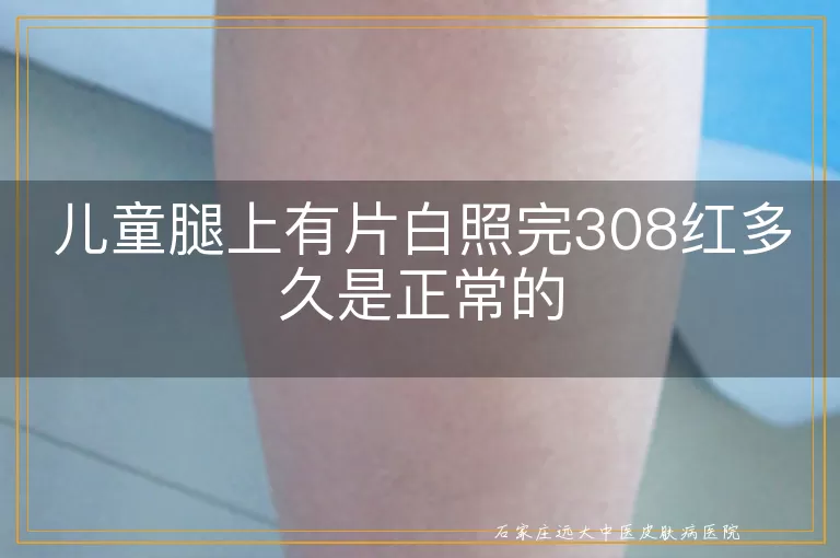 儿童腿上有片白照完308红多久是正常的