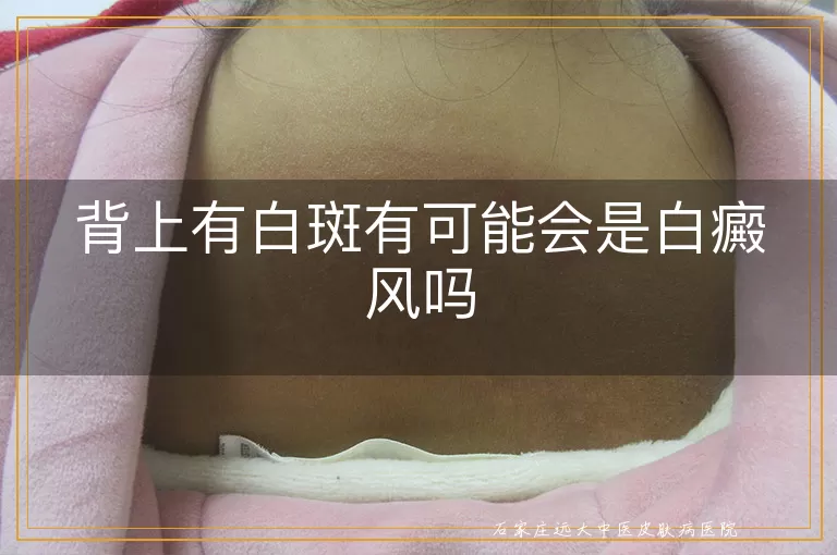 背上有白斑有可能会是白癜风吗
