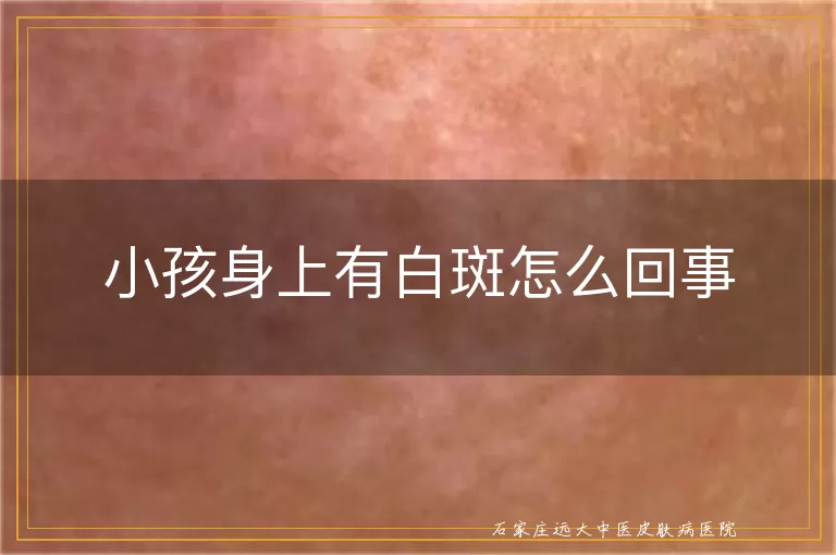 小孩身上有白斑怎么回事