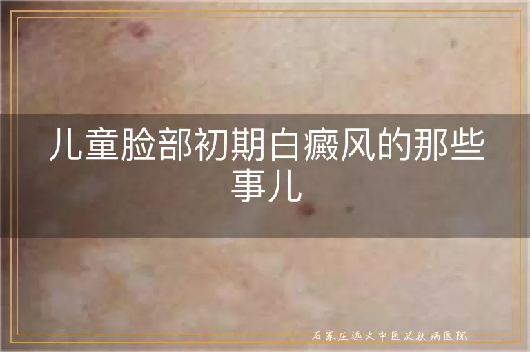 儿童脸部初期白癜风的那些事儿
