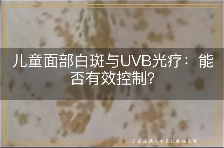 儿童面部白斑与UVB光疗：能否有效控制？