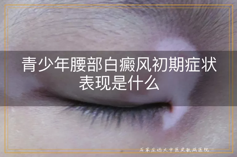 青少年腰部白癜风初期症状表现是什么