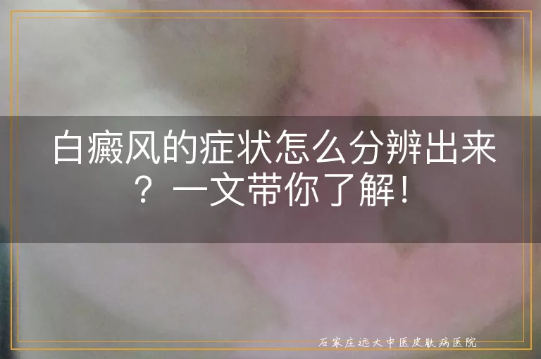 白癜风的症状怎么分辨出来？一文带你了解！