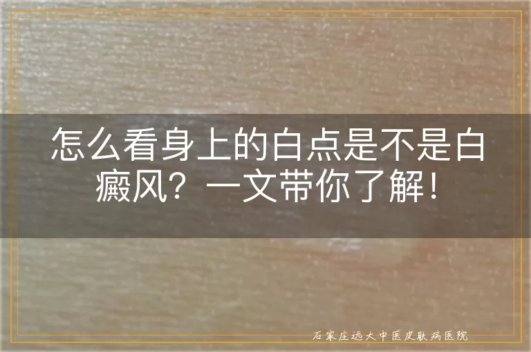 怎么看身上的白点是不是白癜风？一文带你了解！