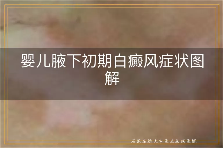 婴儿腋下初期白癜风症状图解