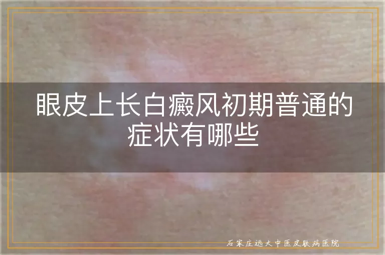 眼皮上长白癜风初期普通的症状有哪些