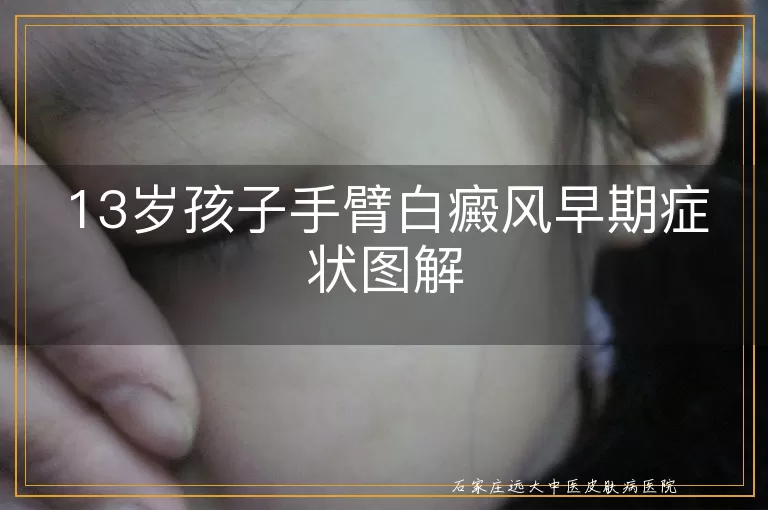 13岁孩子手臂白癜风早期症状图解
