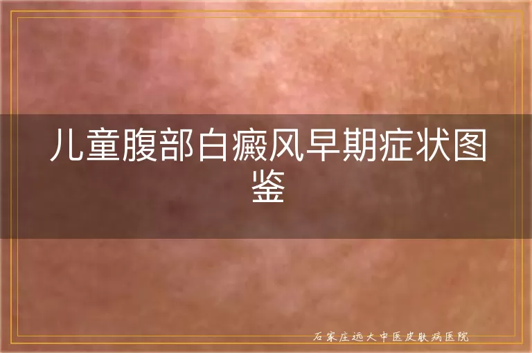 儿童腹部白癜风早期症状图鉴