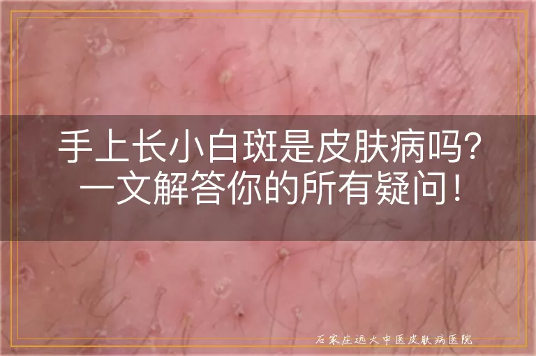手上长小白斑是皮肤病吗？一文解答你的所有疑问！