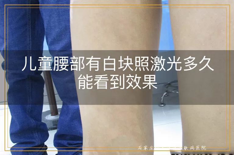 儿童腰部有白块照激光多久能看到效果