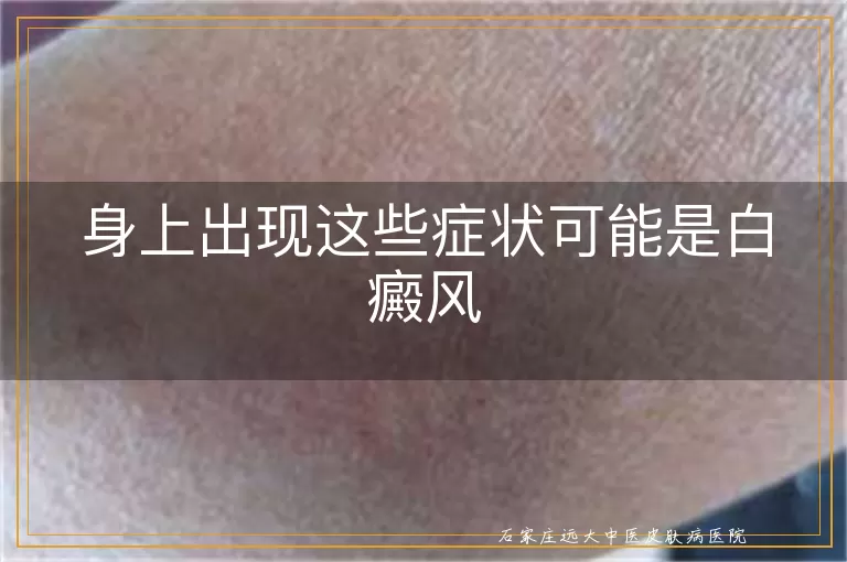 身上出现这些症状可能是白癜风