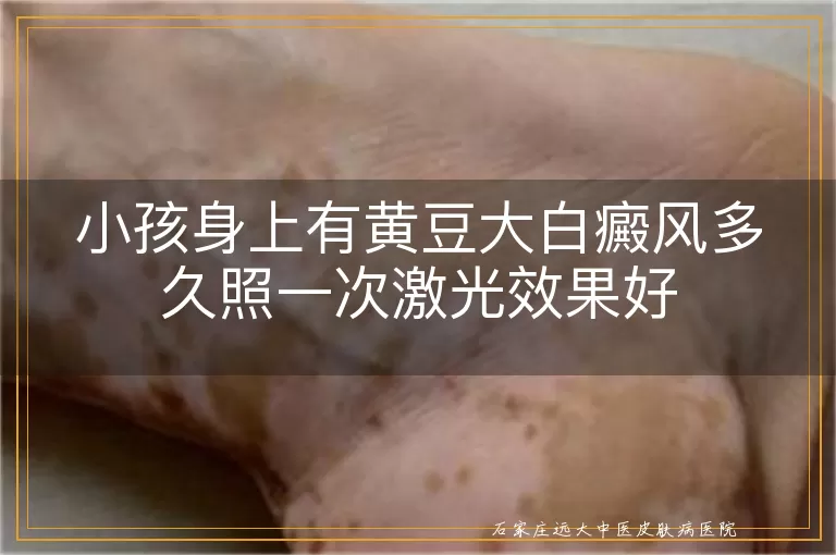 小孩身上有黄豆大白癜风多久照一次激光效果好