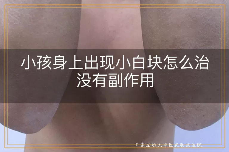 小孩身上出现小白块怎么治没有副作用