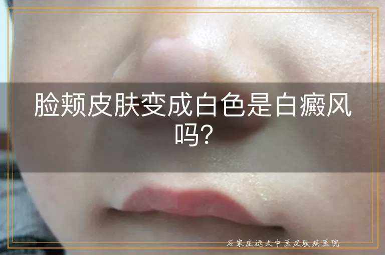 脸颊皮肤变成白色是白癜风吗？