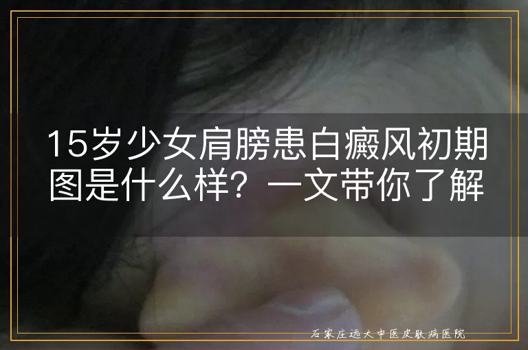 15岁少女肩膀患白癜风初期图是什么样？一文带你了解
