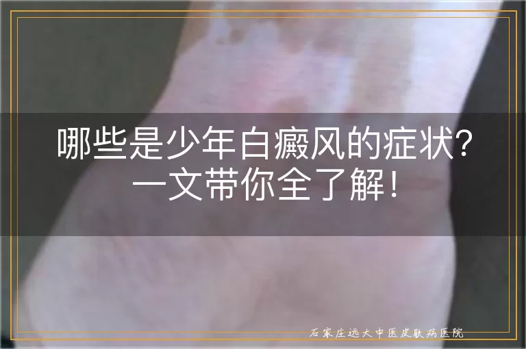 哪些是少年白癜风的症状？一文带你全了解！