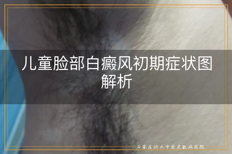 儿童脸部白癜风初期症状图解析
