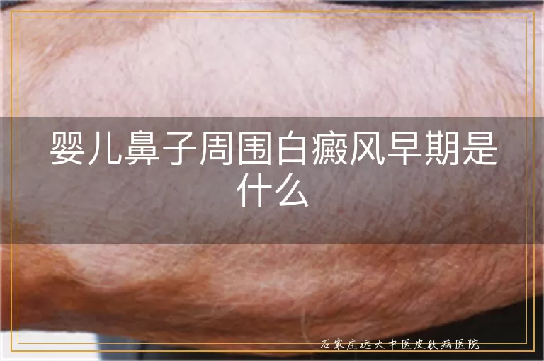 婴儿鼻子周围白癜风早期是什么