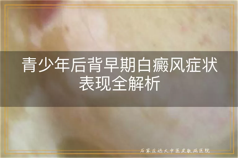 青少年后背早期白癜风症状表现全解析