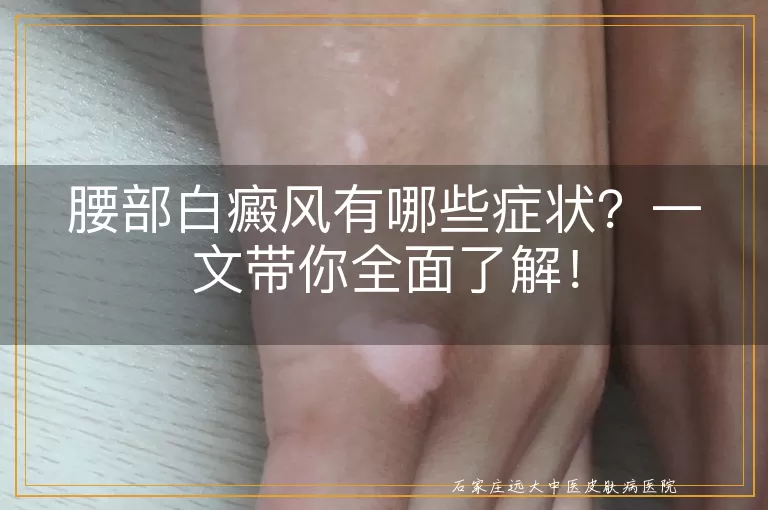 腰部白癜风有哪些症状？一文带你全面了解！