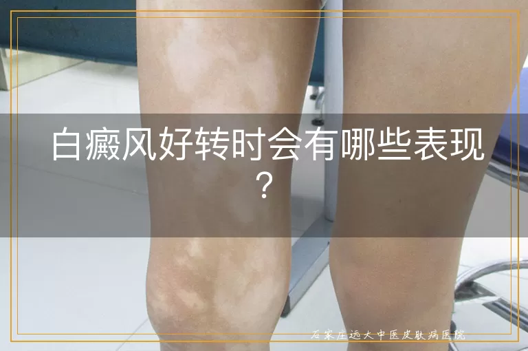 白癜风好转时会有哪些表现？